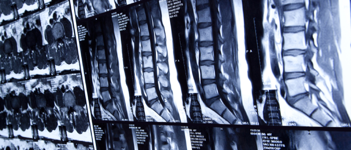 spinal cord scans